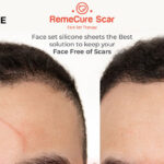 RemeCure Scar face